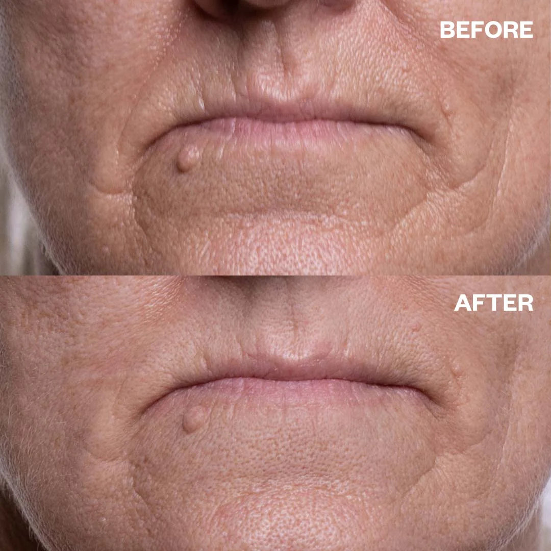 Wrinkles Schminkles | Mouth & Lip Wrinkle Patches Results