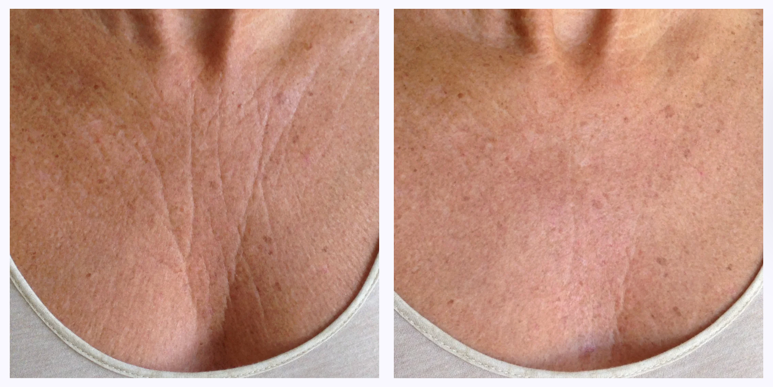 Wrinkles Schminkles | Chest Wrinkle Patch