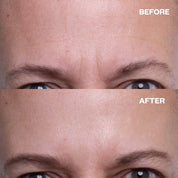 Wrinkles Schminkles | Forehead Wrinkle Patches Results