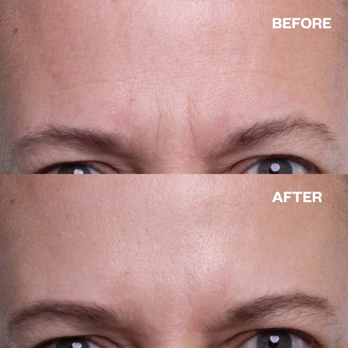 Wrinkles Schminkles | Forehead Wrinkle Patches Results