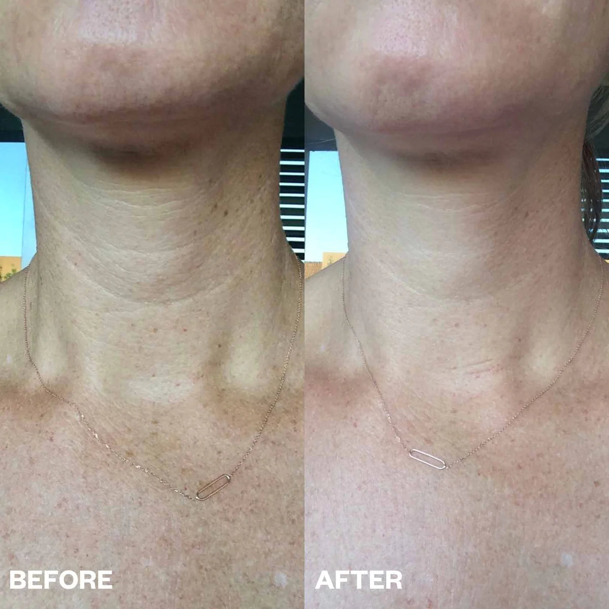 Wrinkles Schminkles | Neck Wrinkle Patch Results