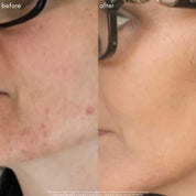 Maya Chia The Straight A Serum Advanced Gentle Retinol Srum Results