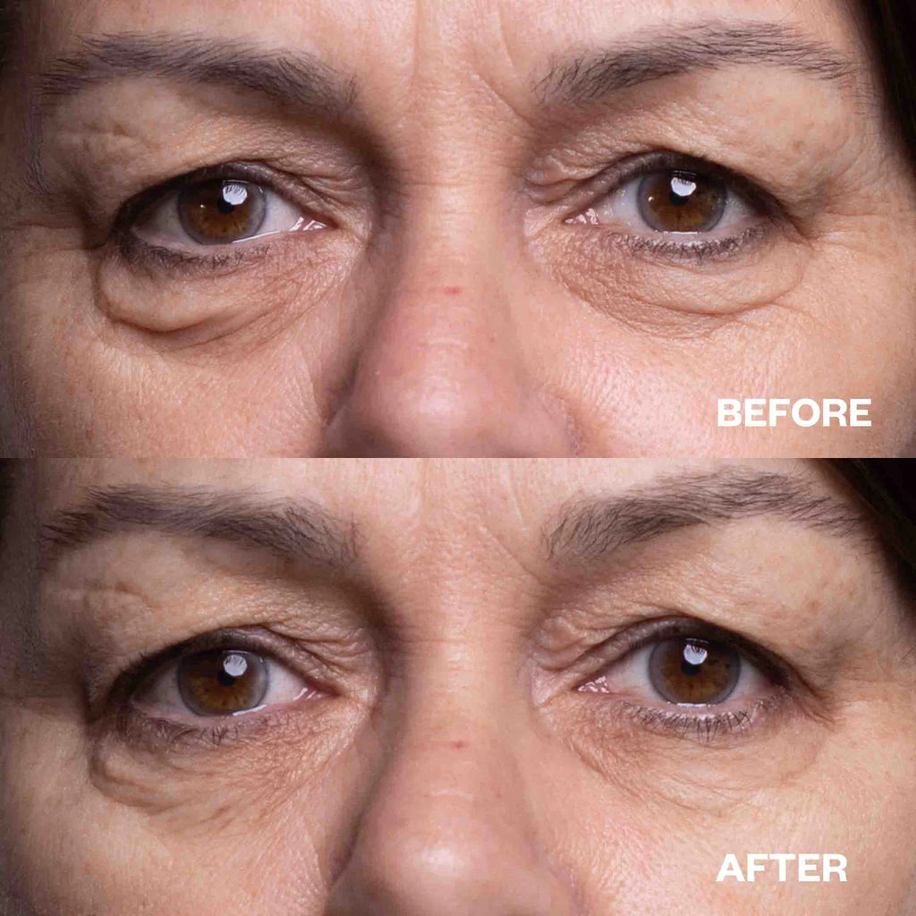 Wrinkles Schminkles | Eye Wrinkle Patches before & after